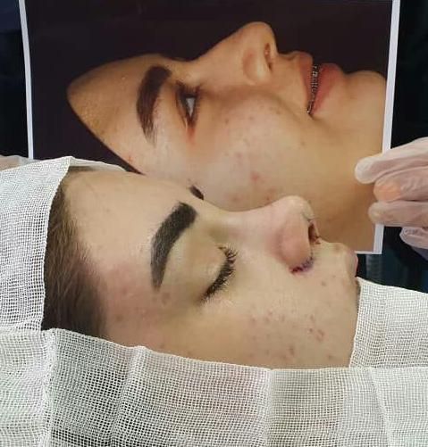 عمل بینی با تخفیف جشنواره تابستانه ویژه فقط ۲۵تومن|خدمات آرایشگری و زیبایی|تهران, عباس‌آباد|دیوار