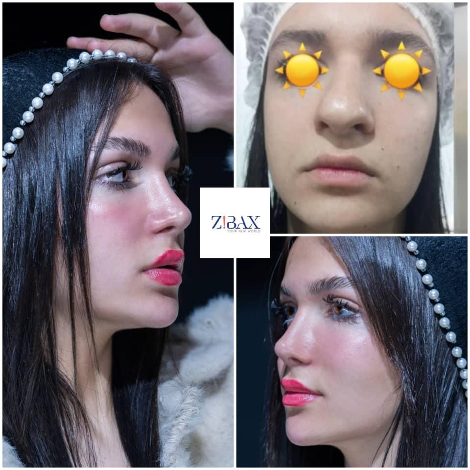 عمل بینی فقط 25م باروش جدید/بدون درد+مشاوره رایگان|خدمات آرایشگری و زیبایی|شیراز, فرهنگ شهر|دیوار