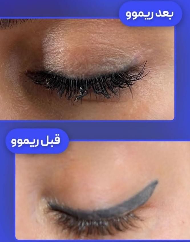 پاک کردن تتوی صورت شما تخصص ماست|خدمات آرایشگری و زیبایی|تهران, منیریه|دیوار