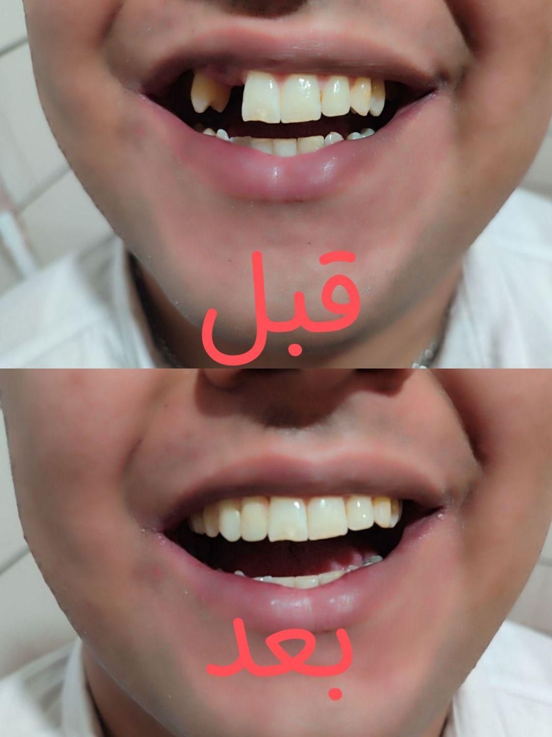 دندان مصنوعی از دم قسط|خدمات آرایشگری و زیبایی|اصفهان, شیخ طوسی|دیوار