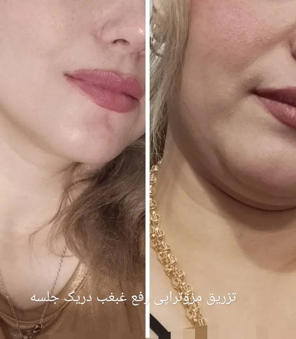 ژل وبوتاکس.برداشتن خال.فیلربینی انزیم پاککردن تاتو|خدمات آرایشگری و زیبایی|مشهد, طبرسی شمالی|دیوار