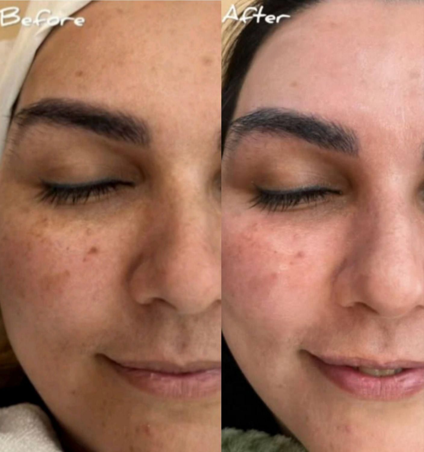 پاکسازی پوست و جوان سازی پوست|خدمات آرایشگری و زیبایی|اراک, |دیوار