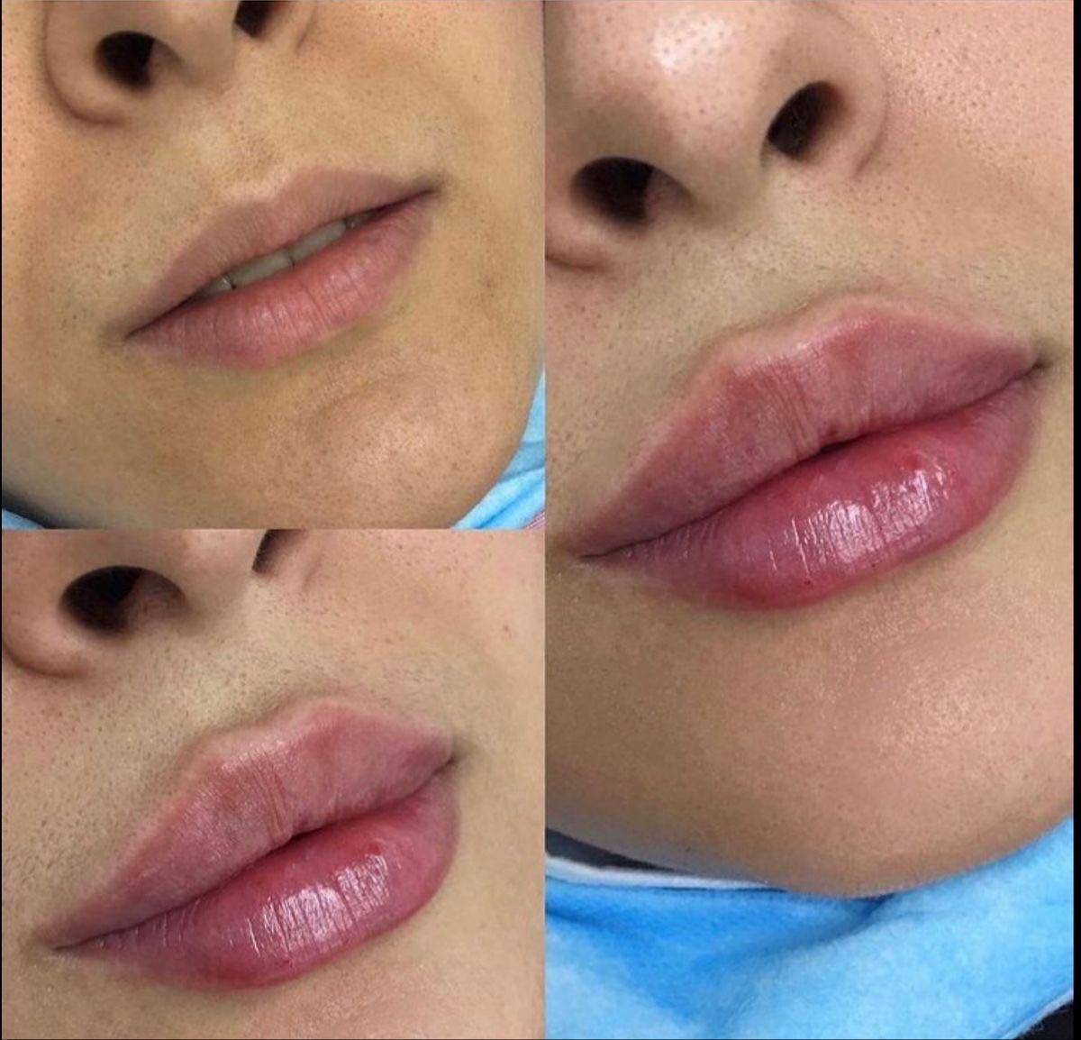 لیزر‌موزائد،ژل بوتاکس مزو،ریمو تتو،هایفو فیشال|خدمات آرایشگری و زیبایی|تهران, جیحون|دیوار