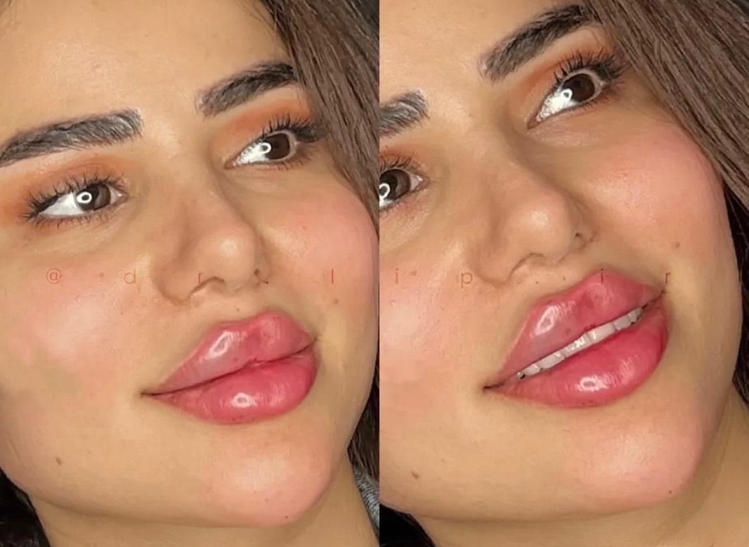 ژل لب روسی بوتاکس هیرفیلر کانتورینگ لیفت صورت|خدمات آرایشگری و زیبایی|تهران, دریا|دیوار