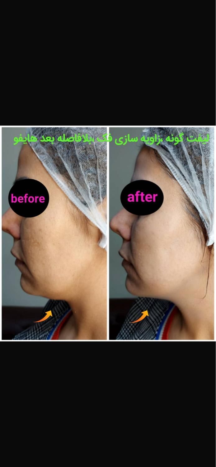 جشنواره  تابستانه ی هایفو ۷ بعدی فقط به مدت ۱۰ روز|خدمات آرایشگری و زیبایی|تهران, آسمان|دیوار