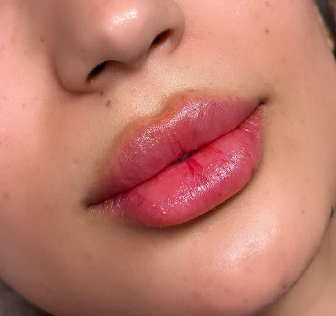 تزریق ژل (فیلر) و بوتاکس|خدمات آرایشگری و زیبایی|شیراز, عادل آباد|دیوار