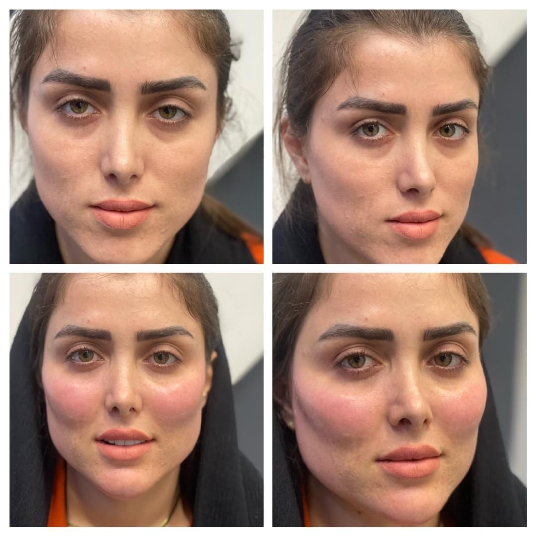 عمل. تزریق چربی صورت بیکینی لابیا پلاستی و بوتاکس|خدمات آرایشگری و زیبایی|رشت, جهاد|دیوار