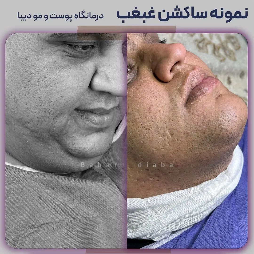 ساکشن غبغب،بلفاروپلاستی،تزریق چربی+قیمت|خدمات آرایشگری و زیبایی|قم, باجک یک|دیوار