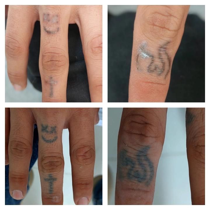 پاک کردن تتو///خدمات لیزر کیوسوئیچ و پیلینگ کربن|خدمات آرایشگری و زیبایی|صدرا-فارس, فاز ۱|دیوار