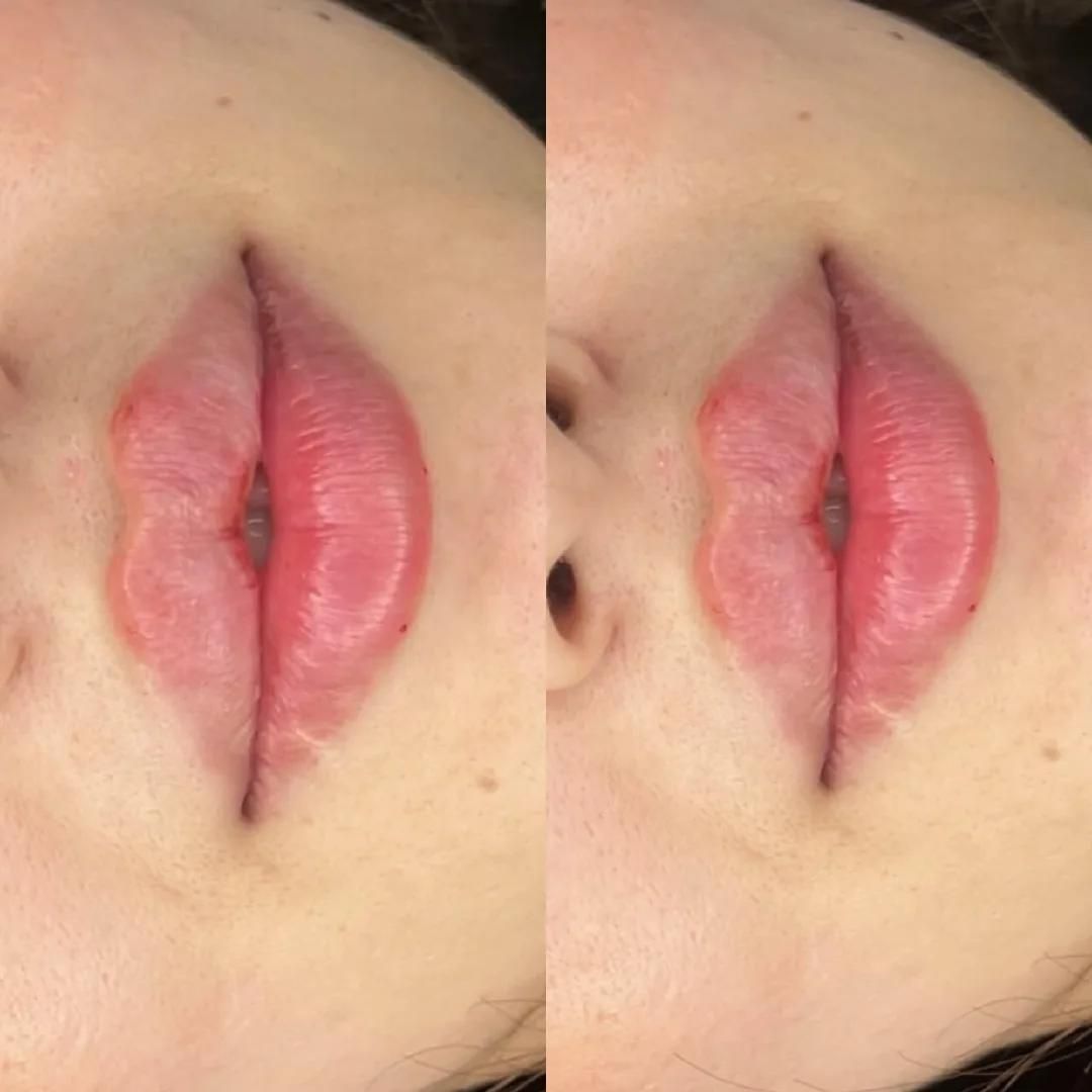 تزریقات ژل .بوتاکس .آنزیم .مزو ژل .مزوسر ضمانتی|خدمات آرایشگری و زیبایی|خرم‌آباد, |دیوار