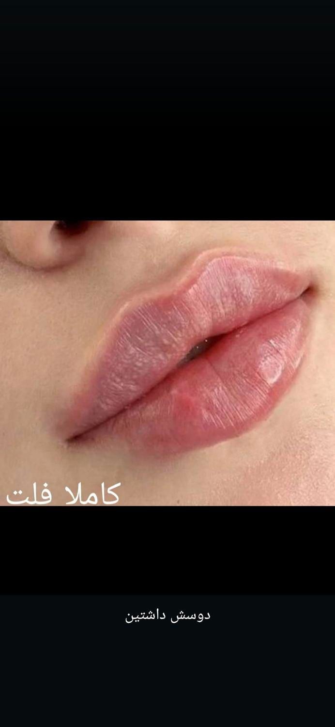 بمب تخفیف ژل و بوتاکس|خدمات آرایشگری و زیبایی|بندر امام خمینی, |دیوار