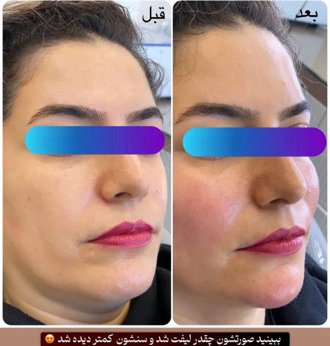بمب تخفیف خدمات زیبایی ژل بوتاکس جوانساز بادی|خدمات آرایشگری و زیبایی|اهر, |دیوار