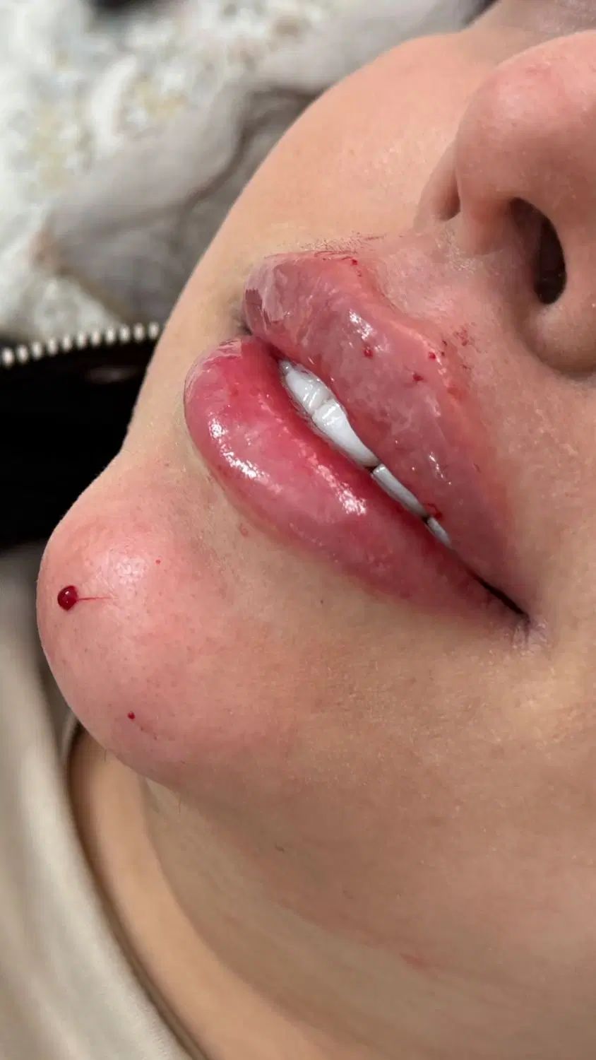 تزریق ژل و بوتاکس و مزو نیدلینگ و فیلر بادی|خدمات آرایشگری و زیبایی|امیدیه, |دیوار