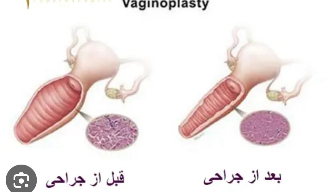 واژینو پلاستی (تنگی واژن)|خدمات آرایشگری و زیبایی|مشهد, راهنمایی|دیوار