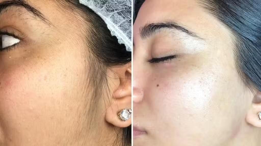 اموزش درماپلنینگ حرفه ای به سبک بیوتی تراپیست ها|خدمات آرایشگری و زیبایی|خاش, |دیوار