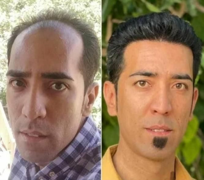 کاشت مو طبیعی،ابرو،و ریش بدون ورم و حتی کبودی|خدمات آرایشگری و زیبایی|یاسوج, |دیوار