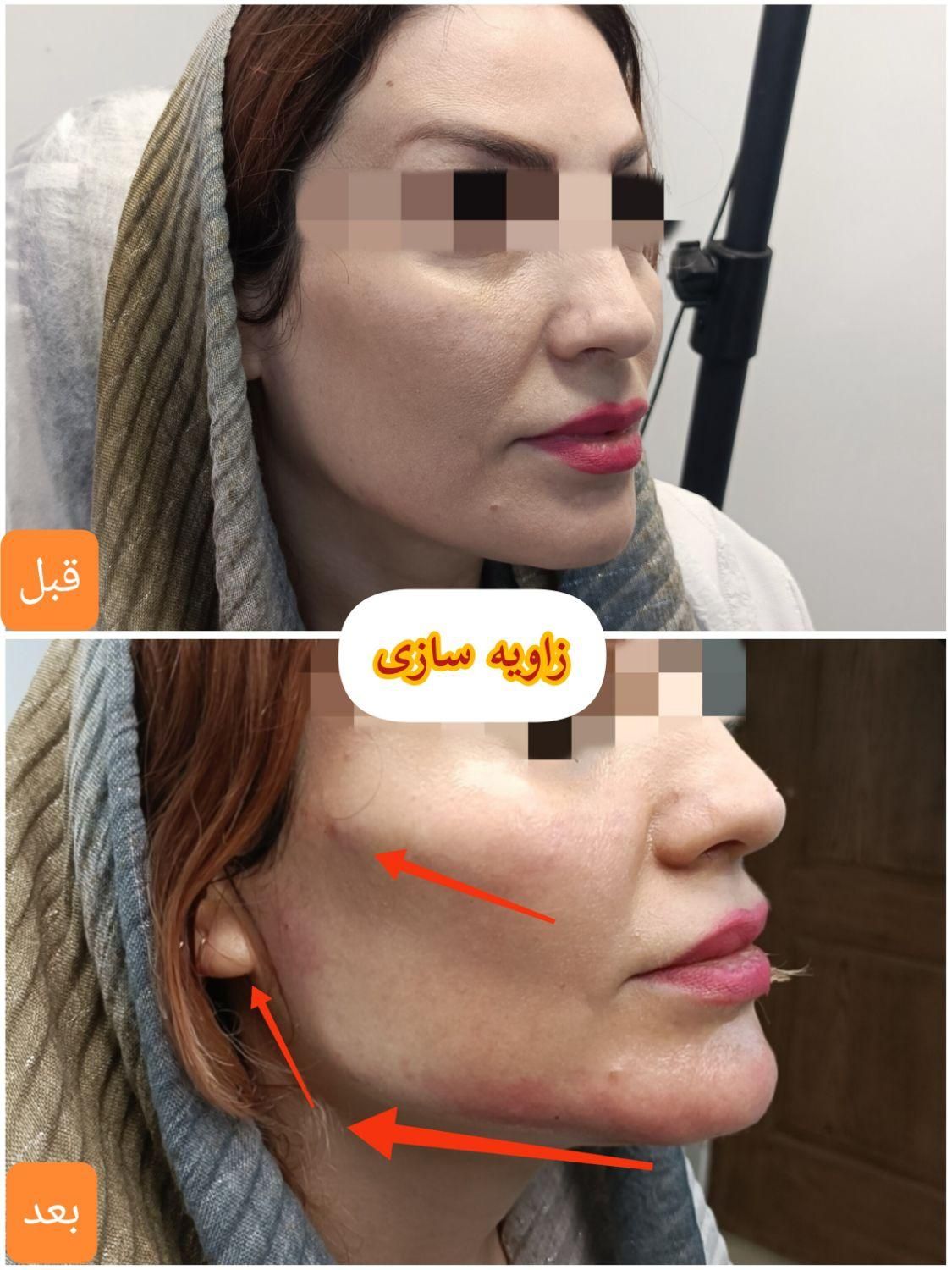 جشنواره تخفیف بوتاکس/ژل/آنزیم‌بینی/فیلرلب/فولفیس|خدمات آرایشگری و زیبایی|شیراز, زرهی|دیوار