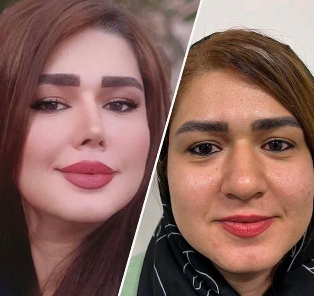 جراحی و عمل بینی با دستگاه پیزو فقط ۲۲/ترمیم بینی|خدمات آرایشگری و زیبایی|فردیس, طالقانی|دیوار