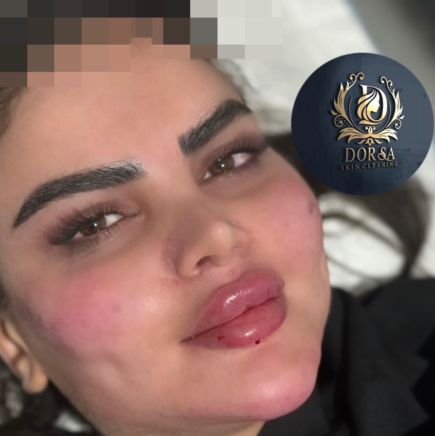 تزریق تخصصی ژل ومادلینگ خلیجی واروپایی وبوتاکس|خدمات آرایشگری و زیبایی|کرمانشاه, |دیوار
