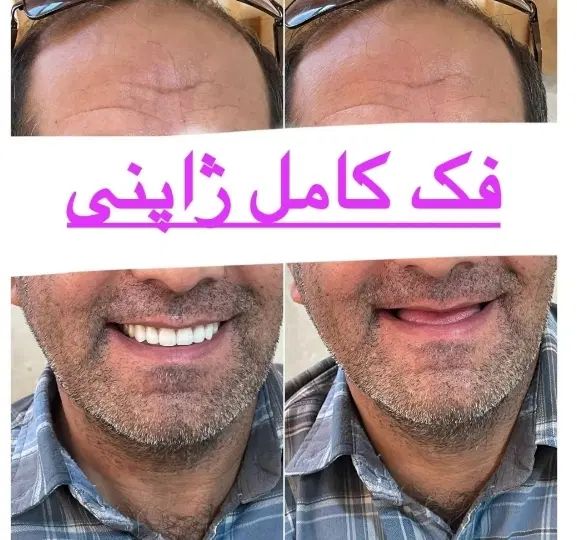 دندانسازی / دندان مصنوعی/ جوان پسند لمینتی/اقساط|خدمات آرایشگری و زیبایی|مشهد, عبادی|دیوار