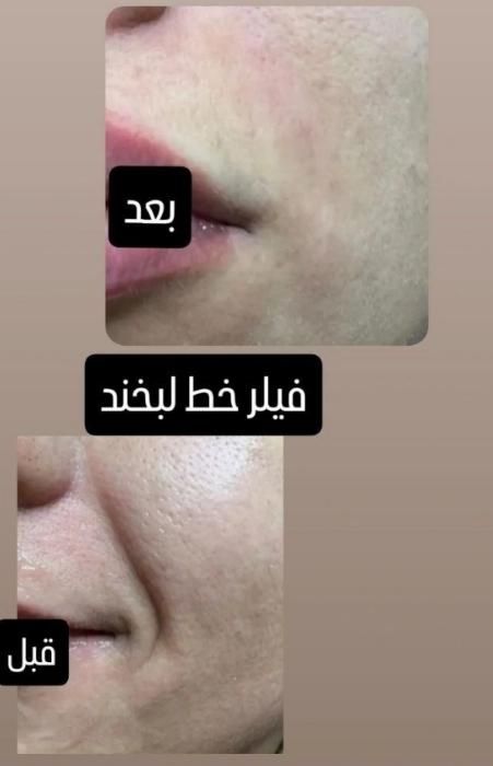 ساکشن چربی و تزریق ژل و بوتاکس و مزو لیفت شقیقه و.|خدمات آرایشگری و زیبایی|کرمانشاه, |دیوار