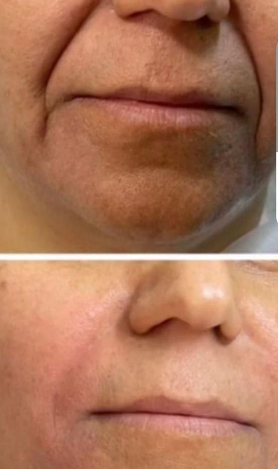 تزریق ژل و بوتاکس|خدمات آرایشگری و زیبایی|بندر کنگان, |دیوار