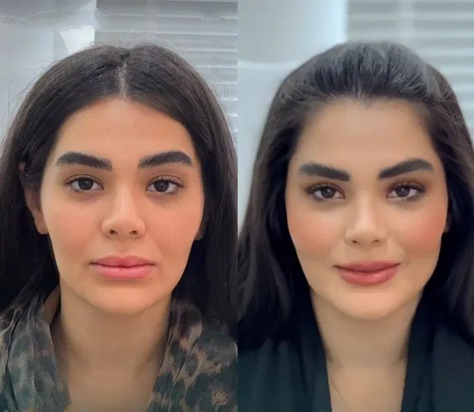 تزریق تخصصی ژل وبوتاکس،هایفو،پاک کردن تتوتوسط پزشک|خدمات آرایشگری و زیبایی|کرمانشاه, |دیوار