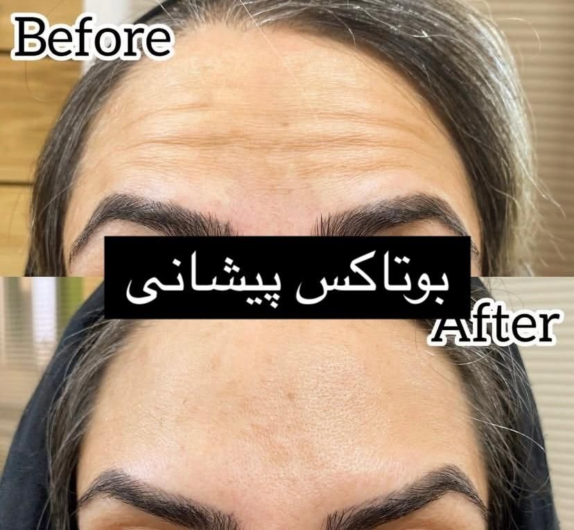 بوتاکس توسط پزشک جهت رفع چین و چروک و لیفت ابرو|خدمات آرایشگری و زیبایی|یزد, |دیوار
