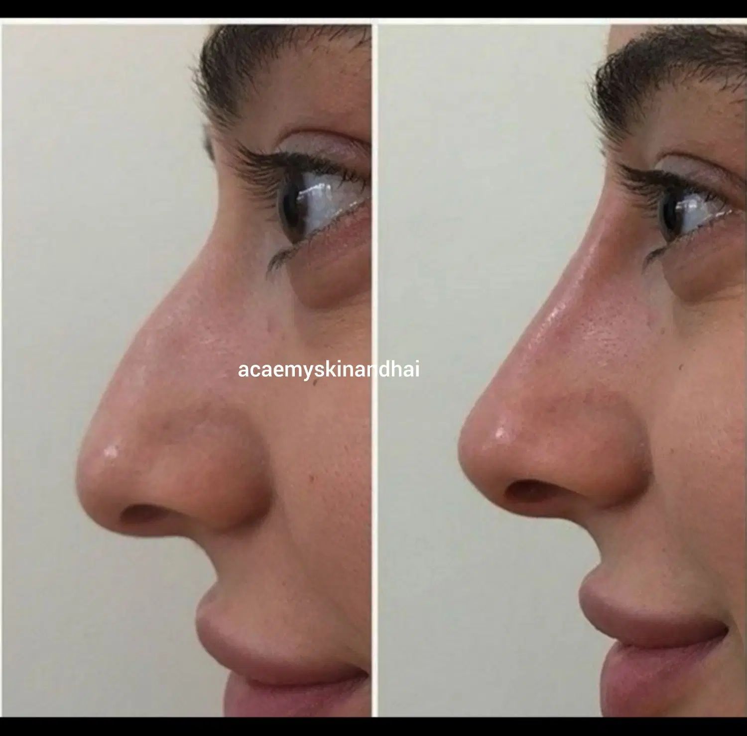 بمب تخفیف ژل ،بوتاکس،نخ وغیره فقط دوهفته لارم|خدمات آرایشگری و زیبایی|لار, |دیوار