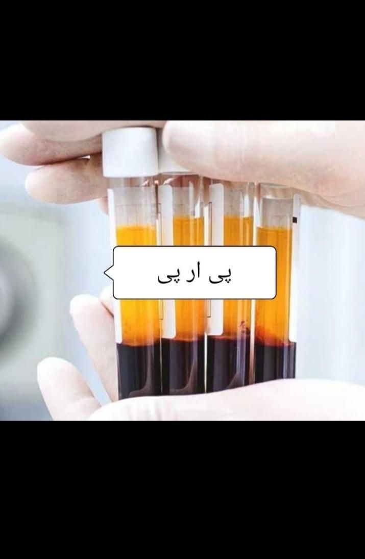 پی ارپی،مزوتراپی مو و صورت|خدمات آرایشگری و زیبایی|خرم‌آباد, |دیوار