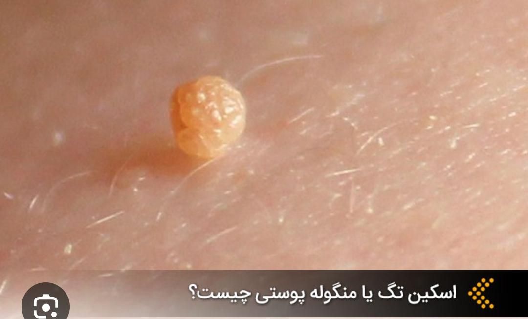 درمانhpvریشه ای زگیل تناسلی زیگیل خال میخچه بواسیر|خدمات آرایشگری و زیبایی|تهران, تهرانپارس غربی|دیوار