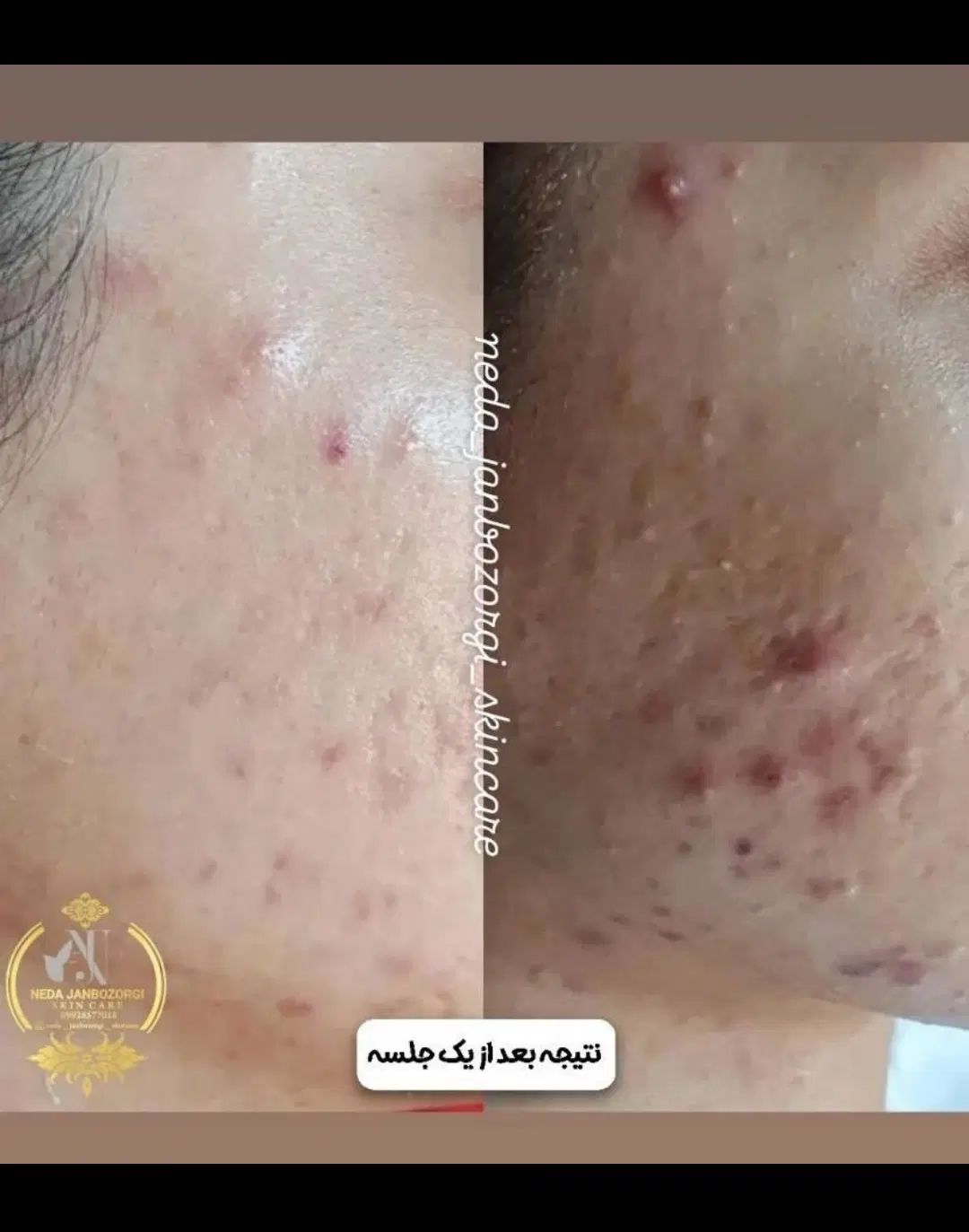 فیشال و پاکسازی پوست زیر نظر متخصص پوست|خدمات آرایشگری و زیبایی|رشت, بوسار|دیوار