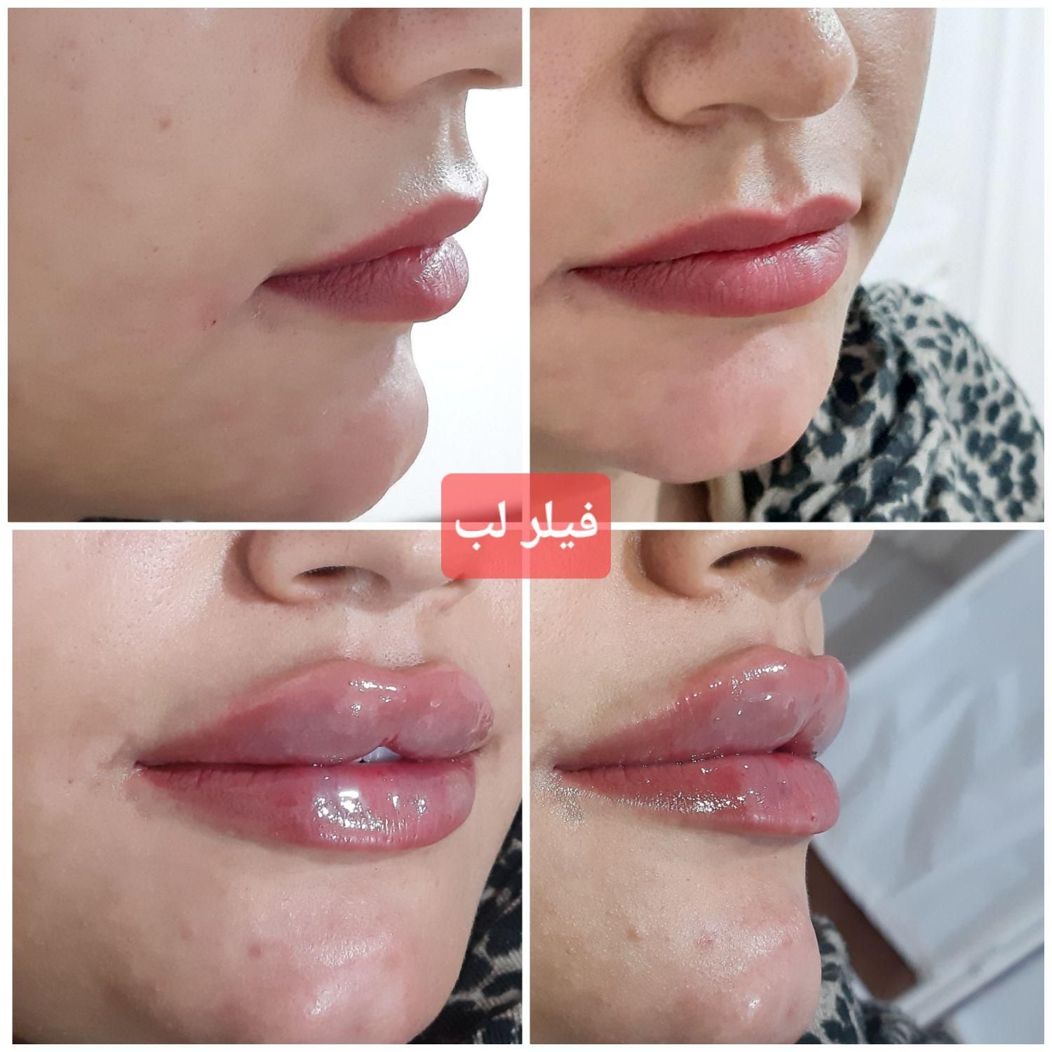 لیزر بوتاکس ژل خالبرداری|خدمات آرایشگری و زیبایی|سیرجان, |دیوار