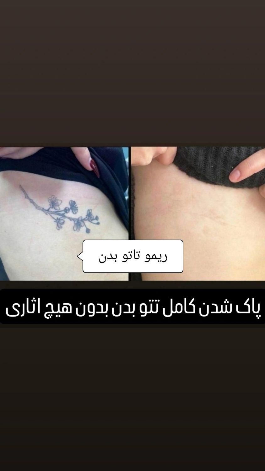 حذف تتو پاک کردن تتو بالیزر/رفع تیرگی/رفع کک و مک|خدمات آرایشگری و زیبایی|مشهد, هنرستان|دیوار