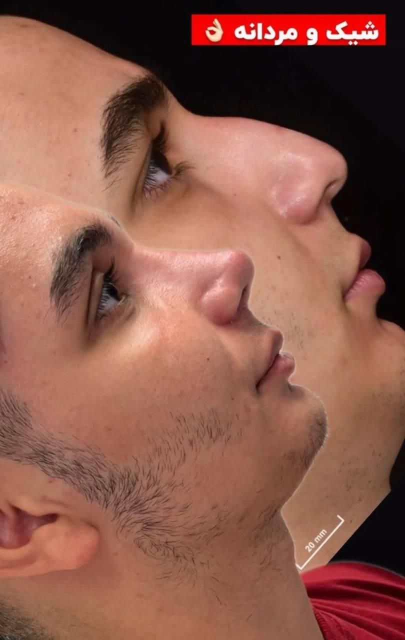 جراحی زیبایی بینی فقط با 22 ملیون|خدمات آرایشگری و زیبایی|شاهرود, |دیوار