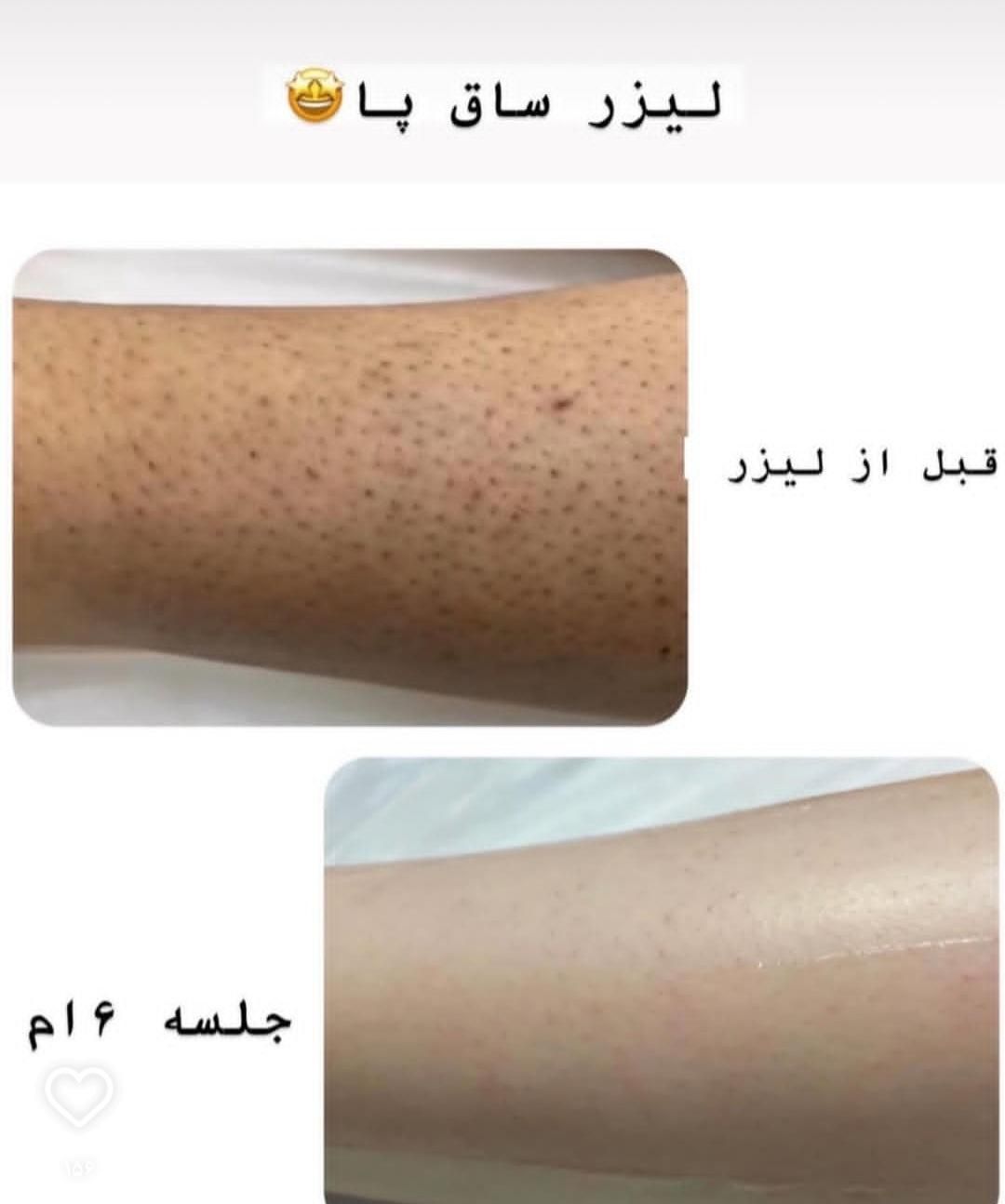 فیشال ولیزر مدیکا ژاندارمری|خدمات آرایشگری و زیبایی|اردبیل, |دیوار