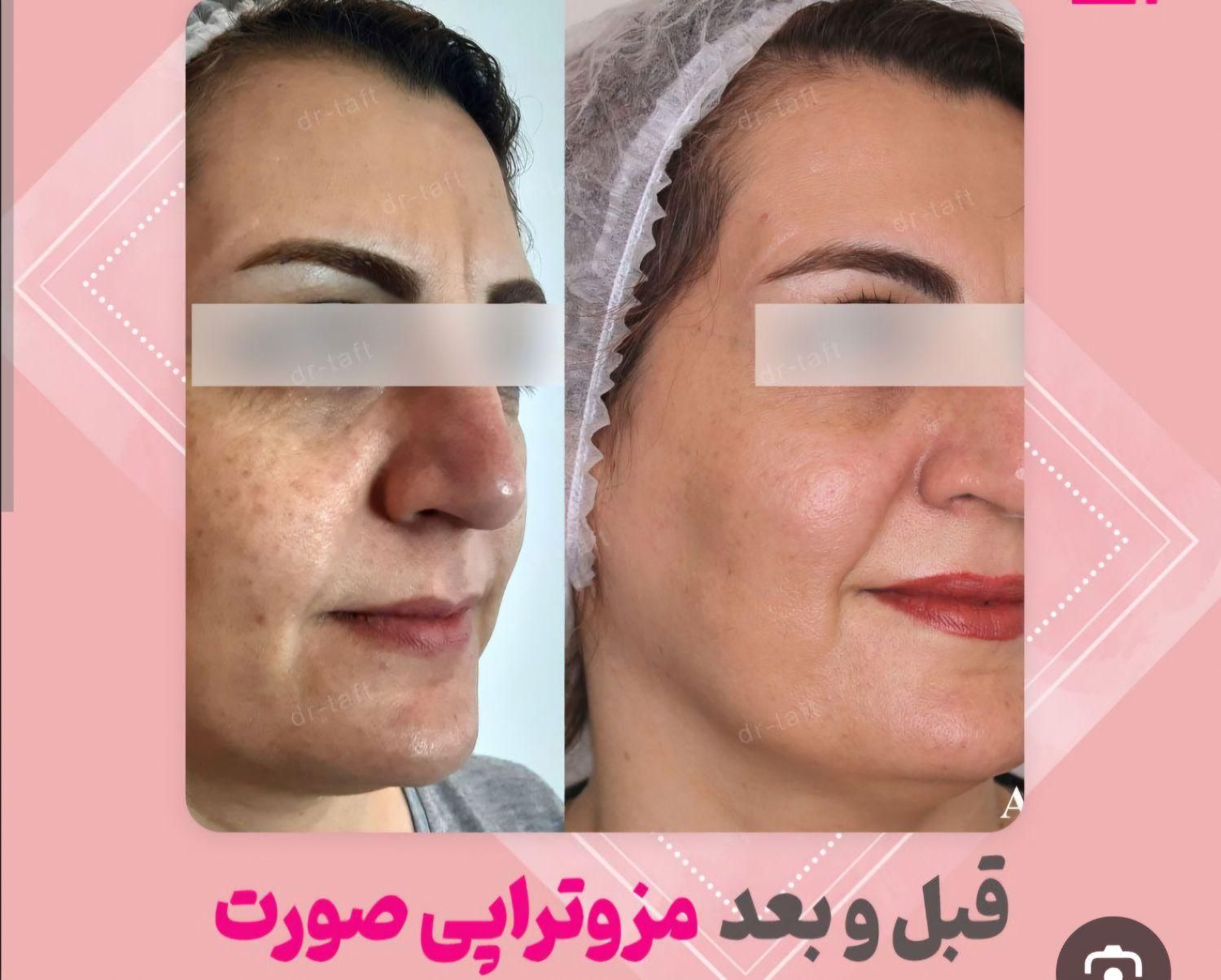 جشنواره *هفت روزه*تزریق ژل و بوتاکس،فیلر،مزوتراپی|خدمات آرایشگری و زیبایی|یاسوج, |دیوار