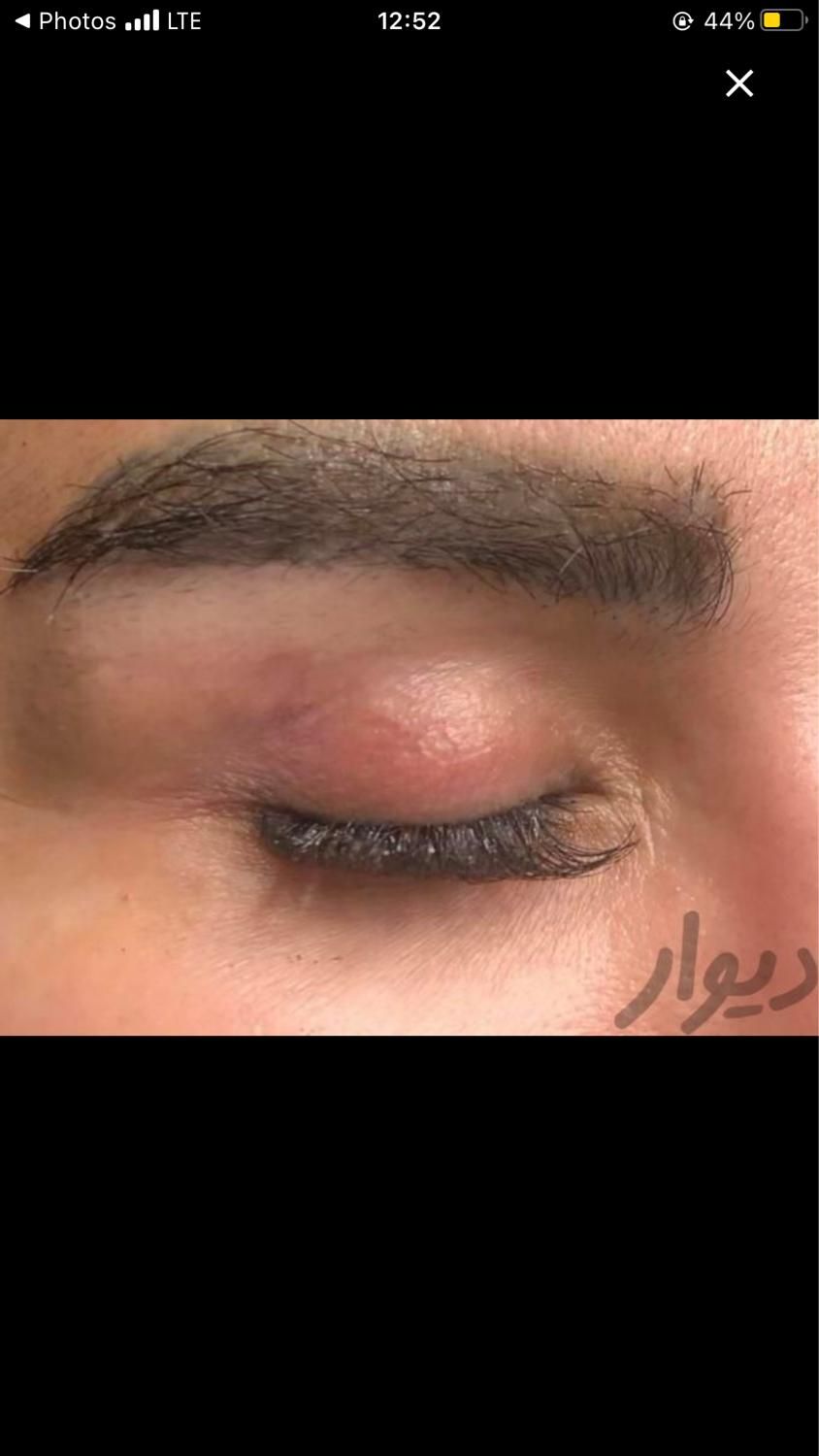 پاک کردن تتو با لیزر کک و مک برداشت خال|خدمات آرایشگری و زیبایی|مشهد, شهید فرامرز عباسی|دیوار