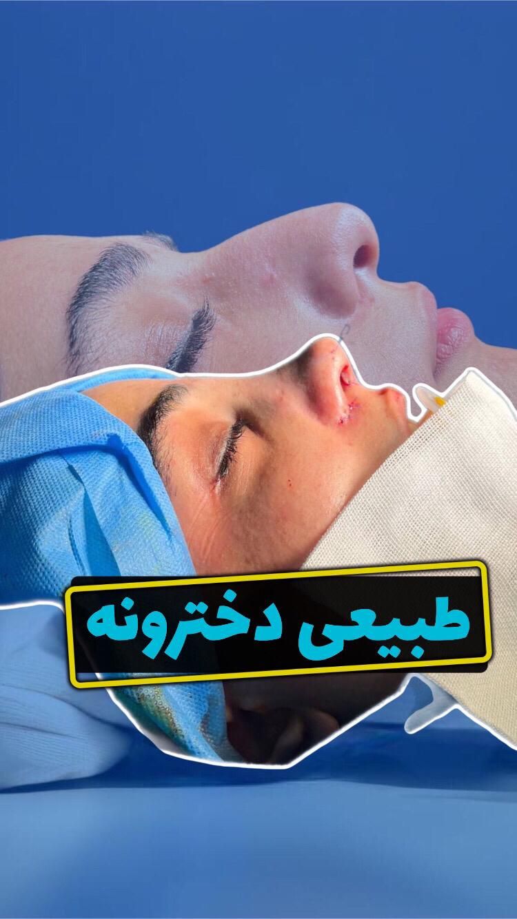 جراحی بینی عمل بینی انواع جراحی زیبایی|خدمات آرایشگری و زیبایی|ساری, |دیوار