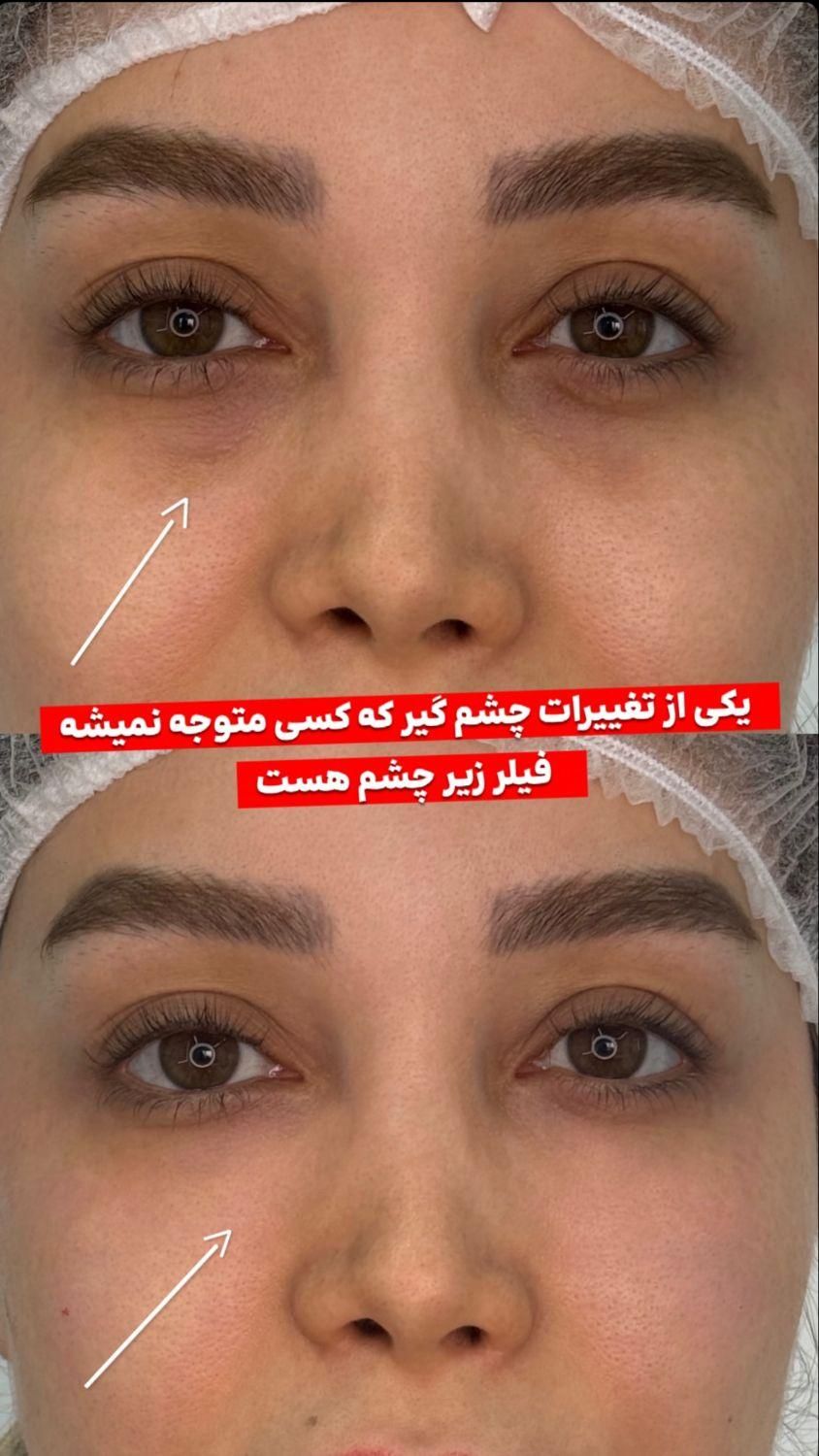 تزریق لب روسی/فیلر بادی/بوتاکس/مزوژل/prp|خدمات آرایشگری و زیبایی|تهران, تهرانپارس غربی|دیوار
