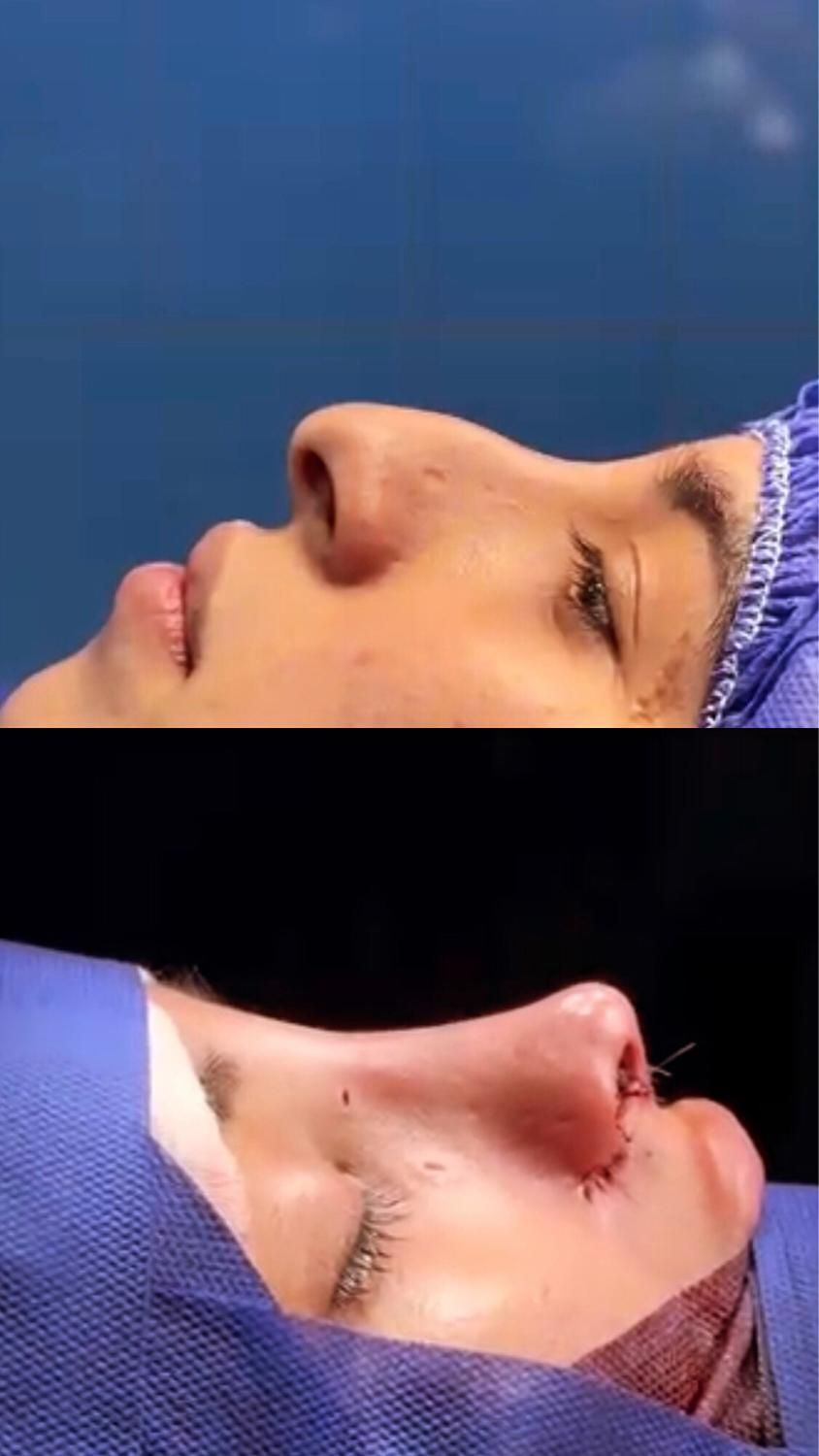 عمل بینی بندرعباس،اقساطی،باکیفیت و تضمین|خدمات آرایشگری و زیبایی|بندرعباس, |دیوار