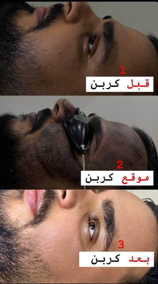 روشن کننده صورت بیکینی ،کربن تراپی تخصصی مابیوتی|خدمات آرایشگری و زیبایی|یاسوج, |دیوار