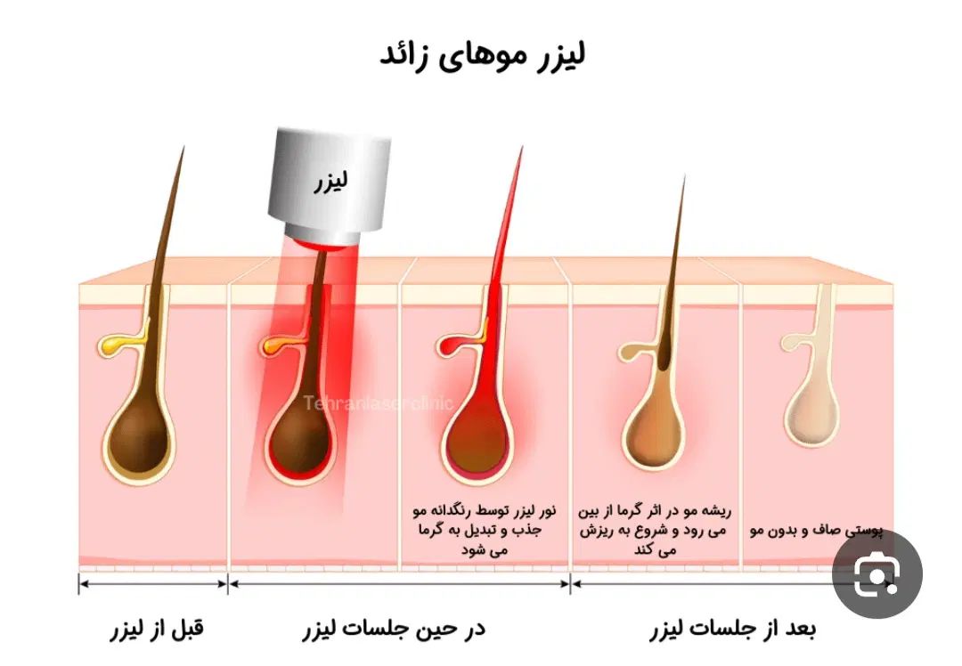 درمان کامل موی بدن لیزرموزائد|خدمات آرایشگری و زیبایی|مشهد, موسوی قوچانی|دیوار