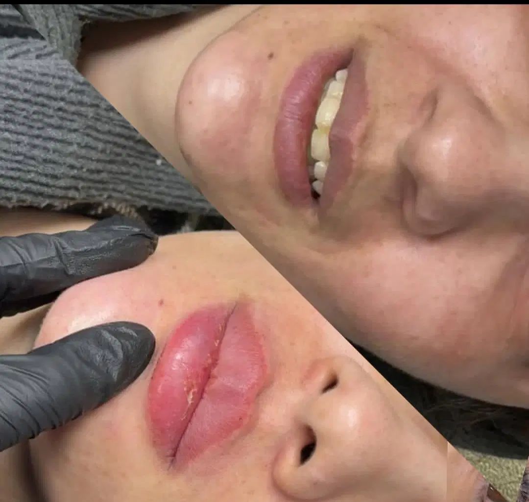ژل بوتاکس فیلر فیشیال مزوتراپی توسط پزشک مجرب|خدمات آرایشگری و زیبایی|شهریار, شهریار|دیوار