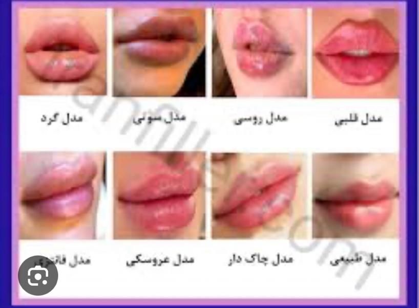 جشنواره تابستانه تزریق ژل و بوتاکس|خدمات آرایشگری و زیبایی|کرج, خرمدشت|دیوار