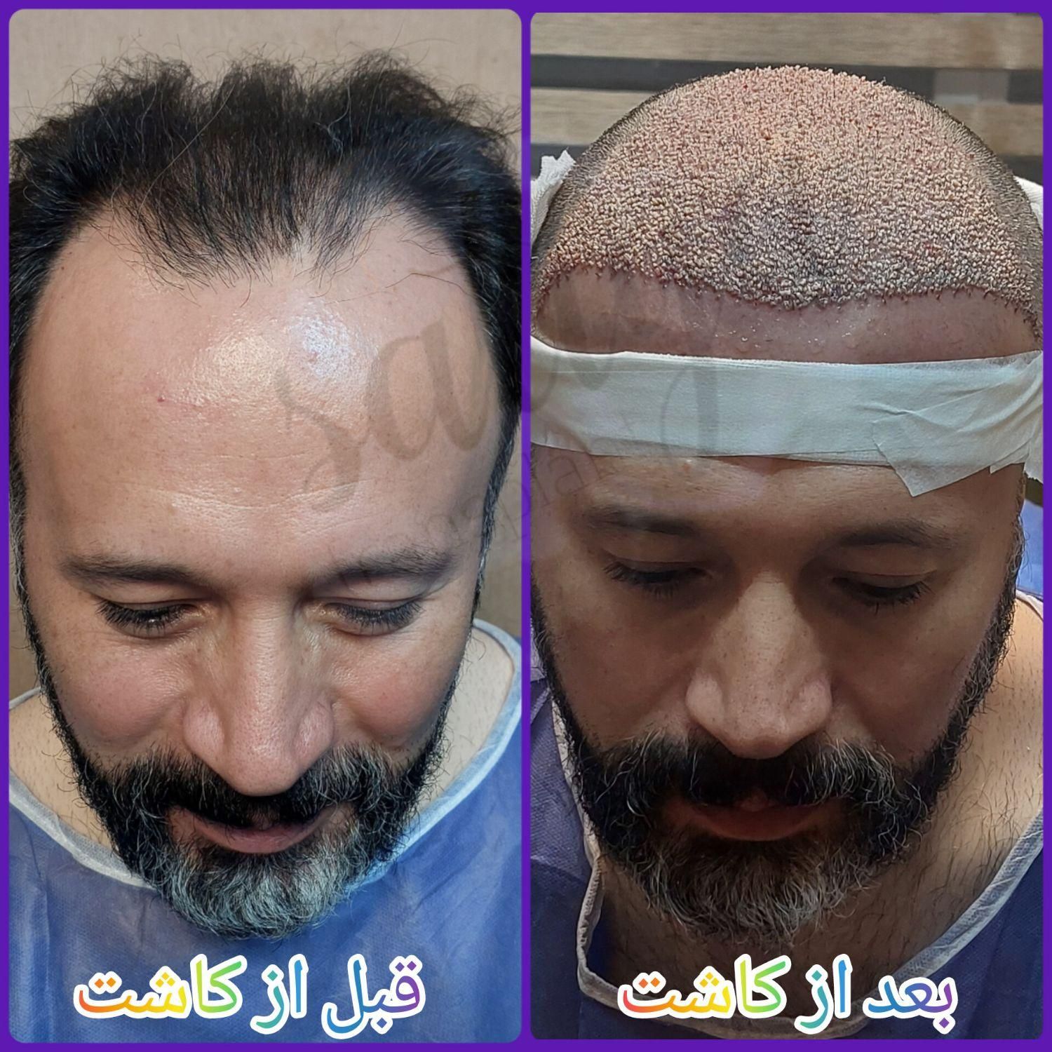 پیوند مو و ابرو در تهران در کلینیک معتبر|خدمات آرایشگری و زیبایی|کاشان, امیرکبیر|دیوار