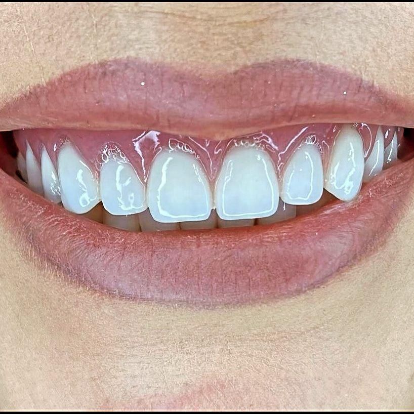 دندانسازی خیریه طرح لمینت|خدمات آرایشگری و زیبایی|مشهد, عامل|دیوار