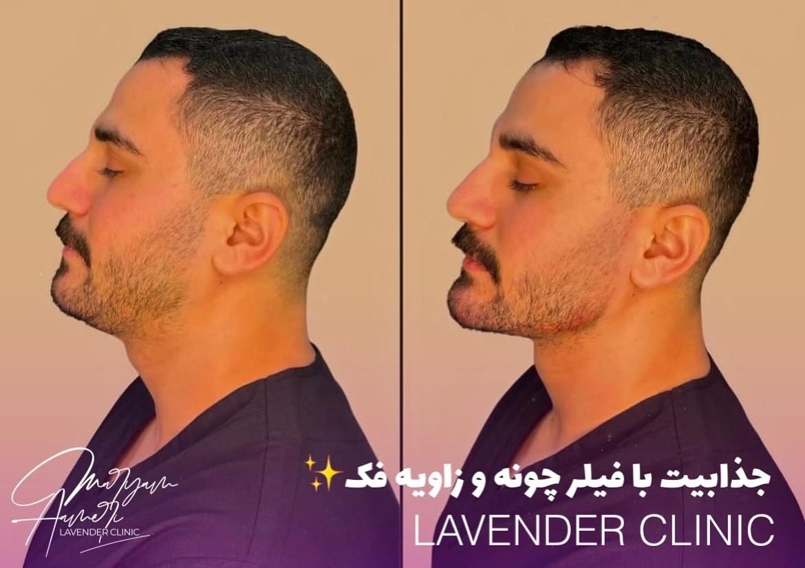جشنوار تابستانه ژل و بوتاکس و شرایط اقساطی|خدمات آرایشگری و زیبایی|آمل, |دیوار