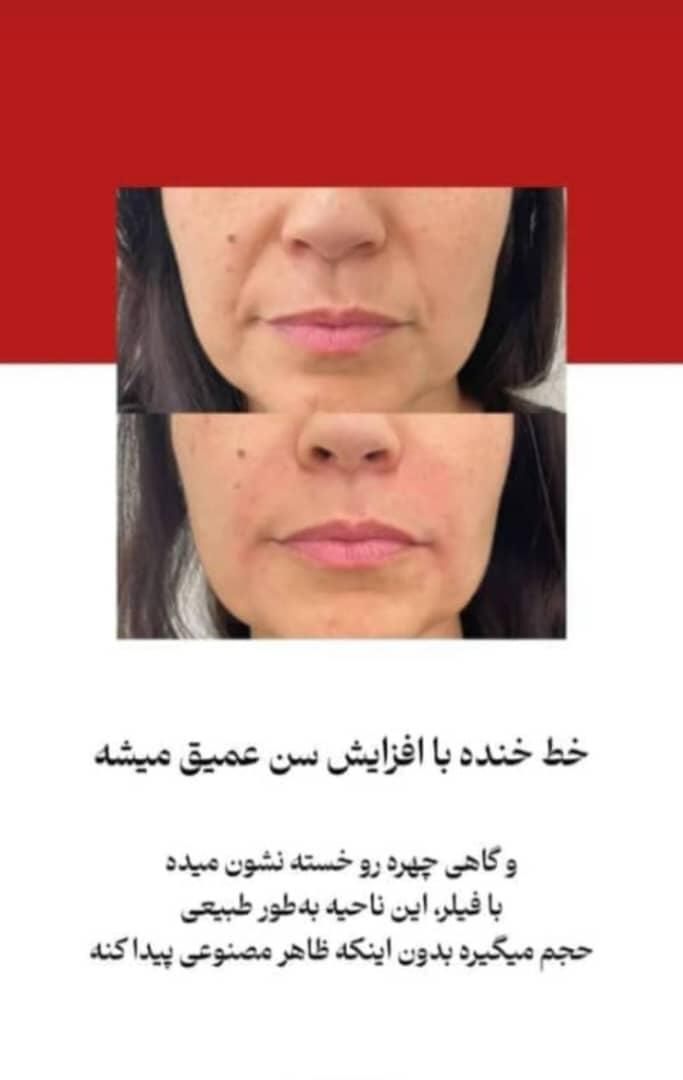 انجام کلیه خدمات تزریق بوتاکس ژل مزو وآنزیم|خدمات آرایشگری و زیبایی|بندر ماهشهر, |دیوار