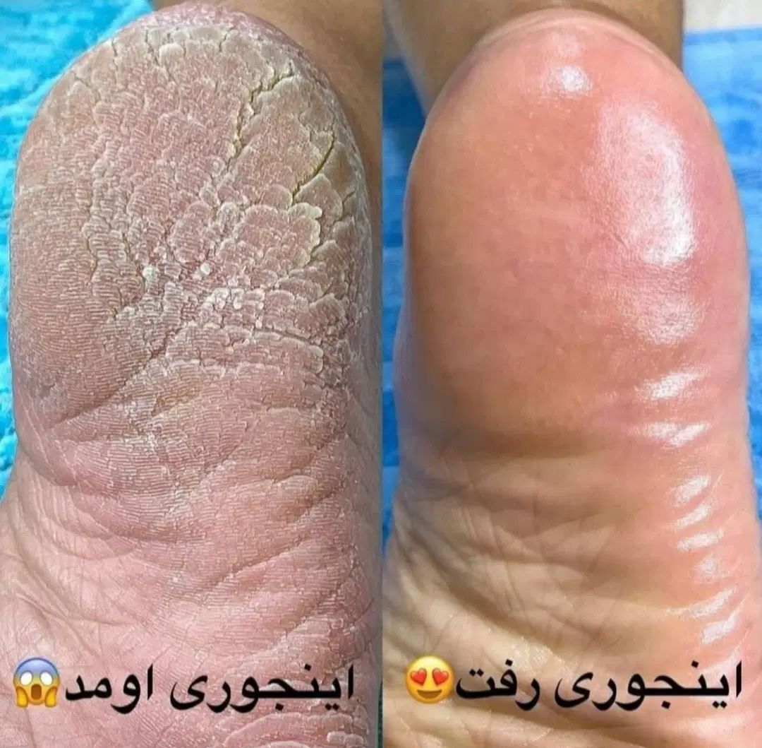 پدیکور درمانی خشک و خیس حتی عزیزانی که پسوریازیس|خدمات آرایشگری و زیبایی|ری, شهرری|دیوار
